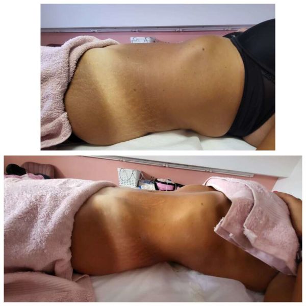 Limfo Remodeling 3